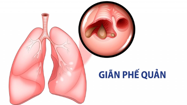 Những biểu hiện thường gặp nghi ngờ giãn phế quản?